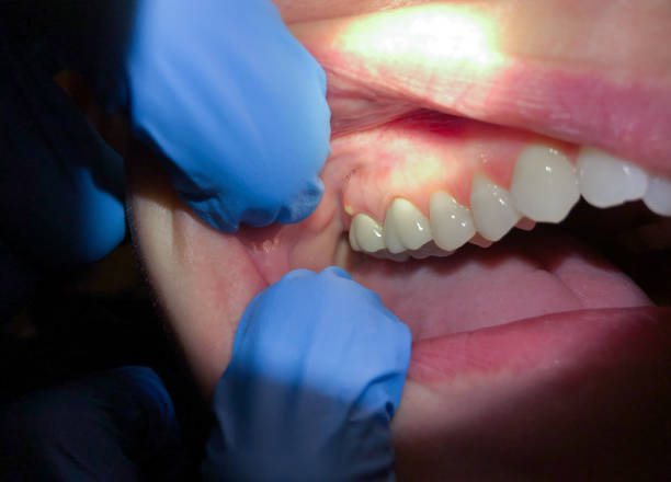 Best Emergency Broken Tooth Repair in Boiling Springs, NC